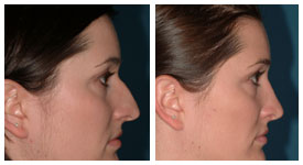Rhinoplasty Treatment Pretoria