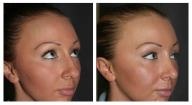 Rhinoplasty Treatment Pretoria