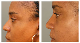 Rhinoplasty Treatment Pretoria