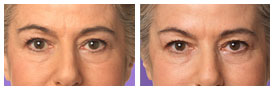 Tissue Filler Treatment Pretoria